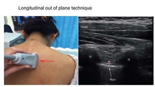 Longitudinal out of plane technique
 