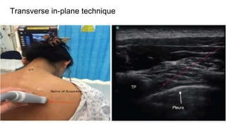 Transverse in-plane technique
 