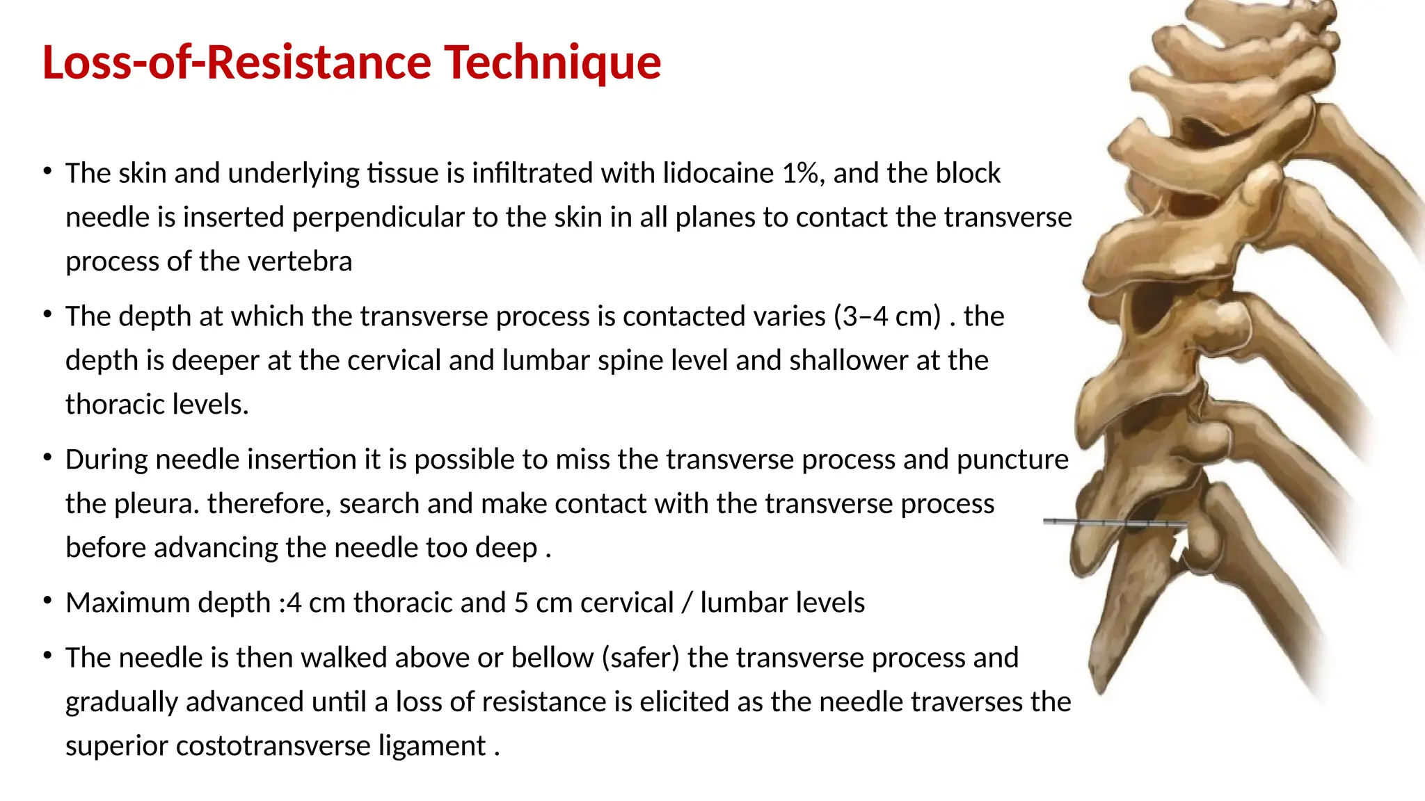 Loss-of-Resistance Technique
• The skin and underlying tissue is infiltrated with lidocaine 1%, and the block
needle is inserted perpendicular to the skin in all planes to contact the transverse
process of the vertebra
• The depth at which the transverse process is contacted varies (3–4 cm) . the
depth is deeper at the cervical and lumbar spine level and shallower at the
thoracic levels.
• During needle insertion it is possible to miss the transverse process and puncture
the pleura. therefore, search and make contact with the transverse process
before advancing the needle too deep .
• Maximum depth :4 cm thoracic and 5 cm cervical / lumbar levels
• The needle is then walked above or bellow (safer) the transverse process and
gradually advanced until a loss of resistance is elicited as the needle traverses the
superior costotransverse ligament .
 