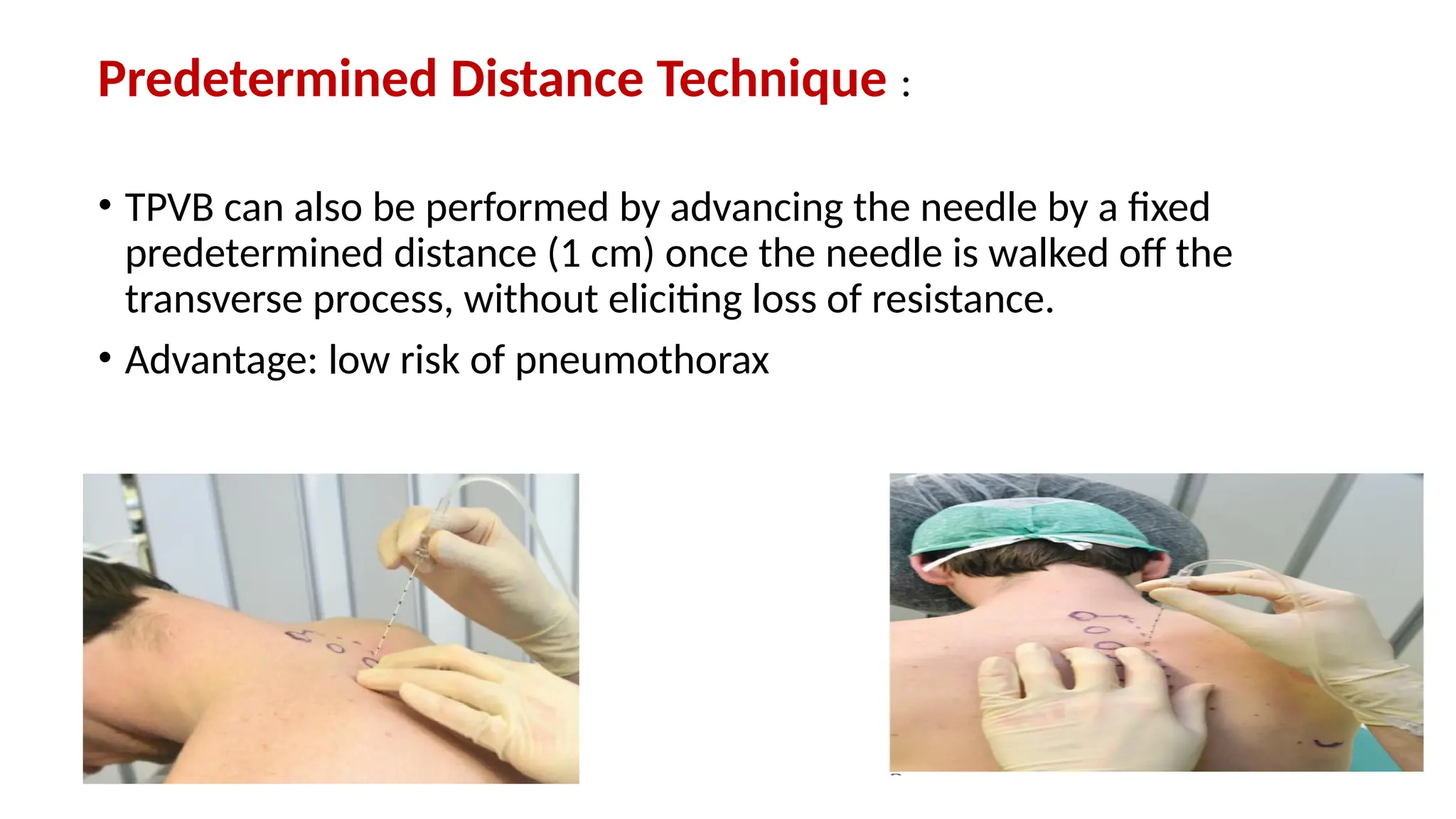 Predetermined Distance Technique :
• TPVB can also be performed by advancing the needle by a fixed
predetermined distance (1 cm) once the needle is walked off the
transverse process, without eliciting loss of resistance.
• Advantage: low risk of pneumothorax
 