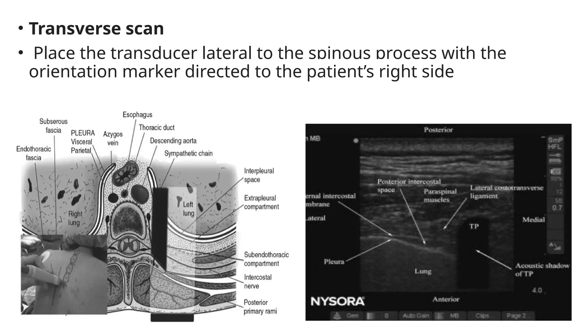 • Transverse scan
• Place the transducer lateral to the spinous process with the
orientation marker directed to the patient’s right side
 