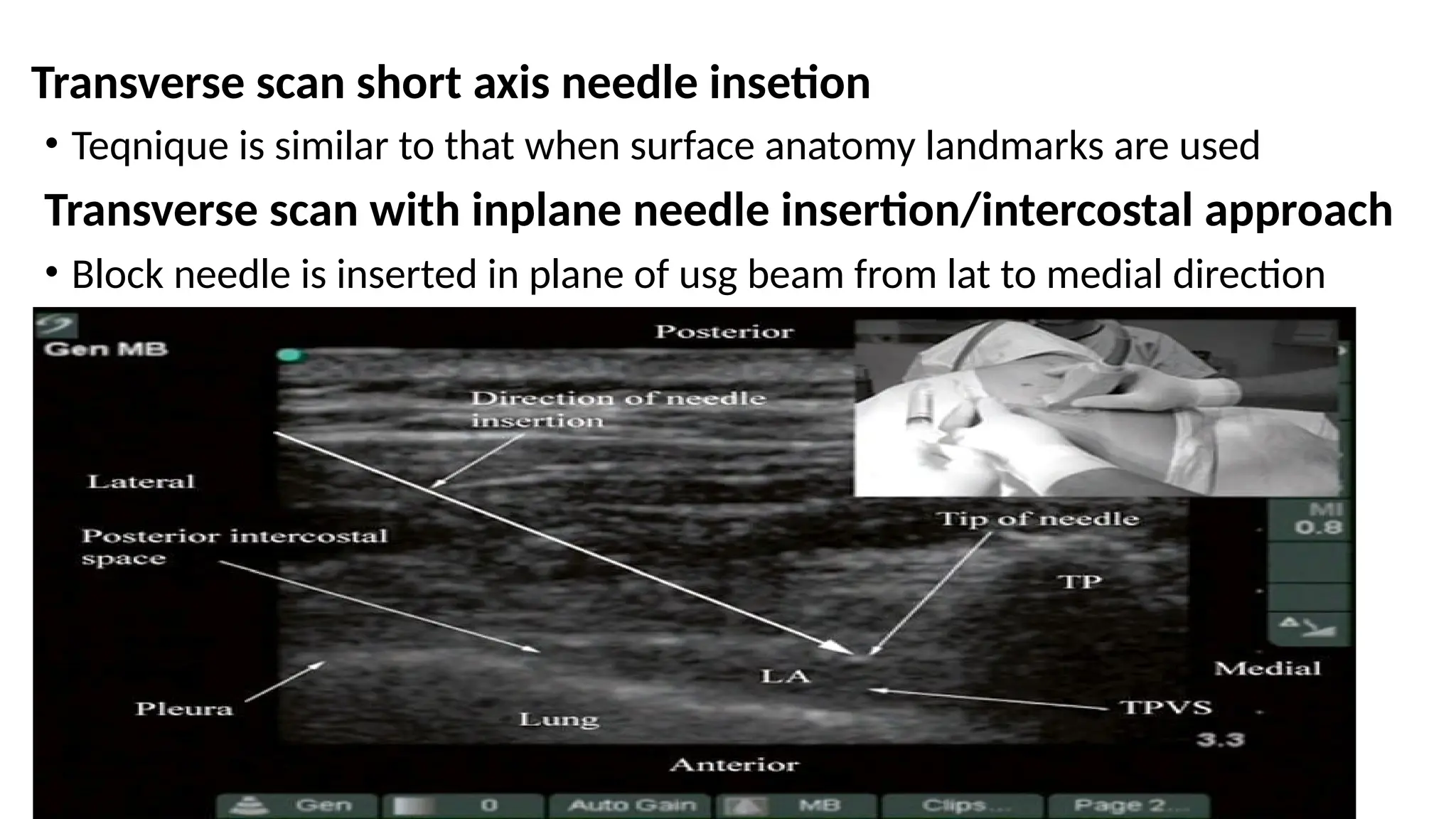 Transverse scan short axis needle insetion
• Teqnique is similar to that when surface anatomy landmarks are used
Transverse scan with inplane needle insertion/intercostal approach
• Block needle is inserted in plane of usg beam from lat to medial direction
 