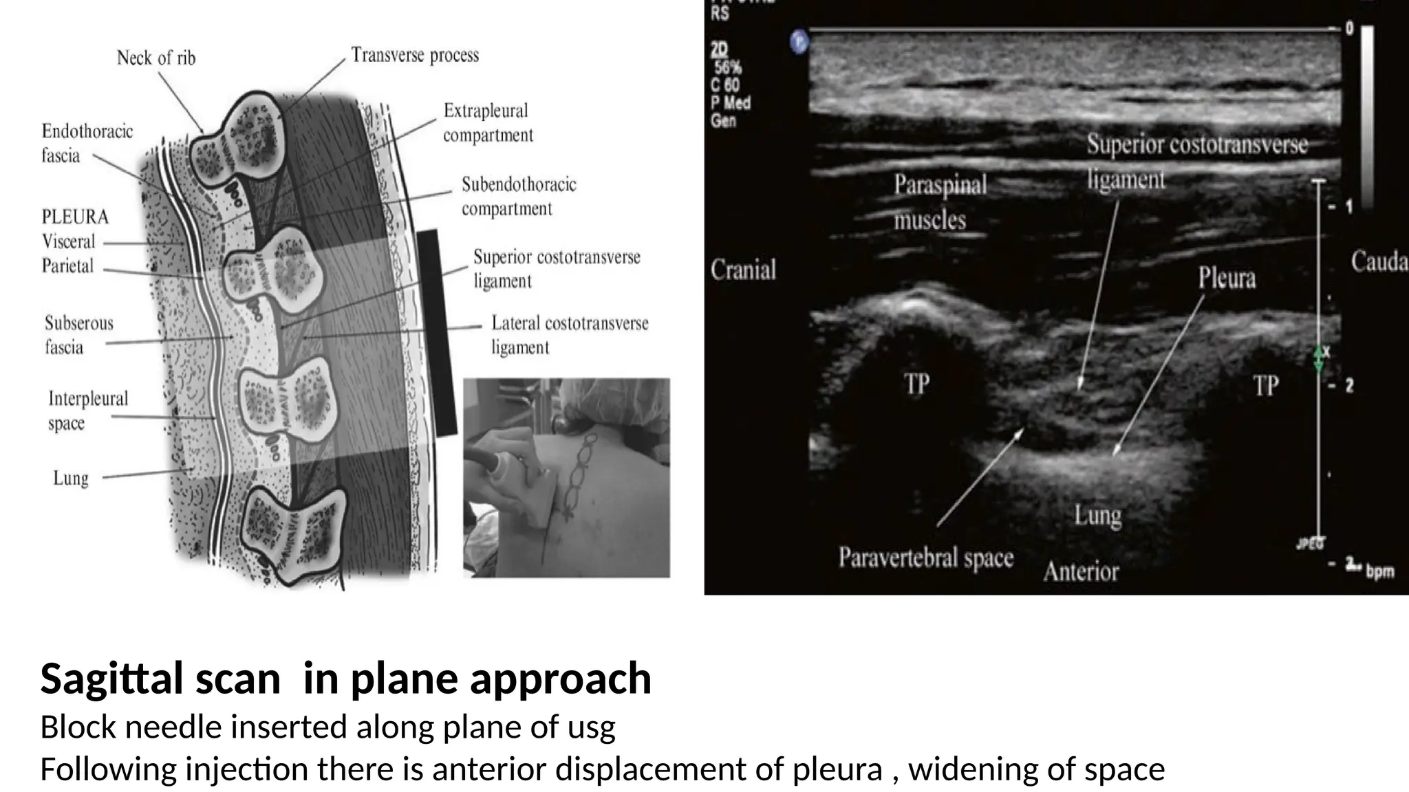 Sagittal scan in plane approach
Block needle inserted along plane of usg
Following injection there is anterior displacement of pleura , widening of space
 