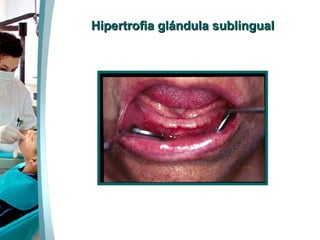 Hipertrofia glándula sublingual 