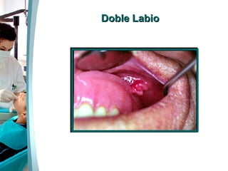 Doble Labio 