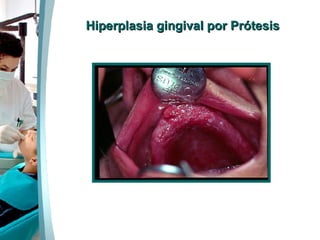 Hiperplasia gingival por Prótesis 