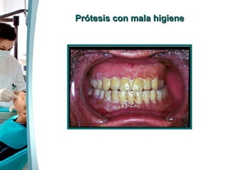 Prótesis con mala higiene 