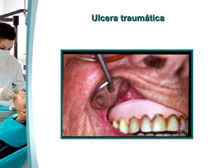 Ulcera traumática 