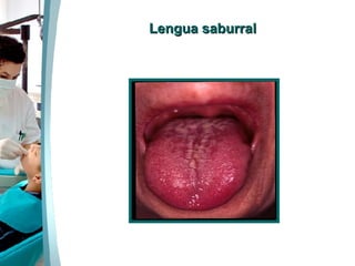 Lengua saburral 