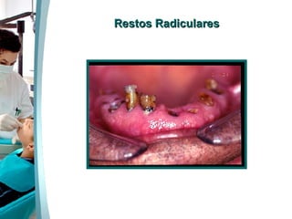 Restos Radiculares 