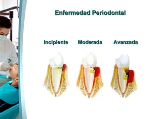Enfermedad Periodontal Incipiente  Moderada  Avanzada 