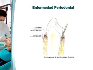 Enfermedad Periodontal 