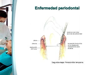 Enfermedad periodontal 