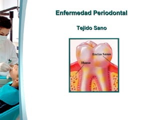 Enfermedad Periodontal Tejido Sano 