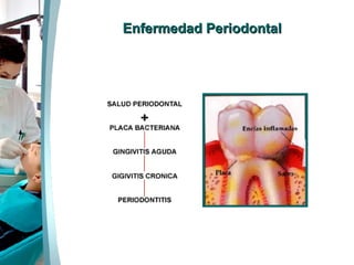 Enfermedad Periodontal 