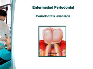 Enfermedad Periodontal Periodontitis  avanzada 