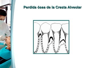 Perdida ósea de la Cresta Alveolar 