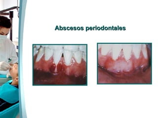 Abscesos periodontales                                