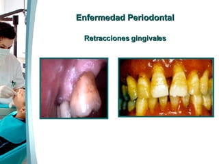 Enfermedad Periodontal Retracciones gingivales 