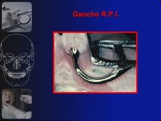 Gancho R.P.I. 