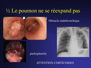 ½ Le poumon ne se réexpand pas
Obstacle endobronchique
pachypleurite
ATTENTION CORTICOIDES
 