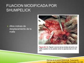 FIJACION MODIFICADA POR
SHUMPELICK
 Altos indices de
desplazamiento de la
malla
Hernias de la pared Abdominal, Tratamiento
Actual. Juan Carlos Mayagoitia Gonzalez. Ed. Alfil.
 
