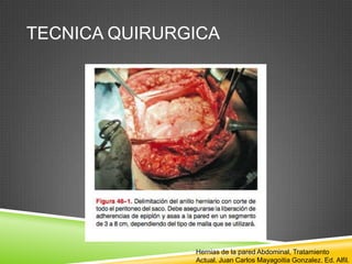 TECNICA QUIRURGICA
Hernias de la pared Abdominal, Tratamiento
Actual. Juan Carlos Mayagoitia Gonzalez. Ed. Alfil.
 