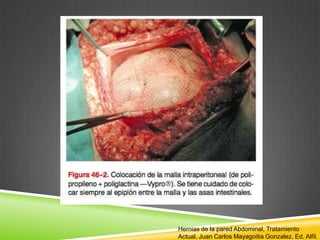 Hernias de la pared Abdominal, Tratamiento
Actual. Juan Carlos Mayagoitia Gonzalez. Ed. Alfil.
 