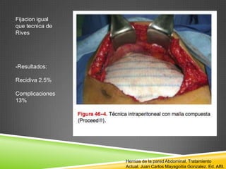 Fijacion igual
que tecnica de
Rives
-Resultados:
Recidiva 2.5%
Complicaciones
13%
Hernias de la pared Abdominal, Tratamiento
Actual. Juan Carlos Mayagoitia Gonzalez. Ed. Alfil.
 