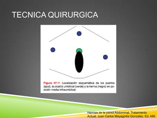 TECNICA QUIRURGICA
Hernias de la pared Abdominal, Tratamiento
Actual. Juan Carlos Mayagoitia Gonzalez. Ed. Alfil.
 