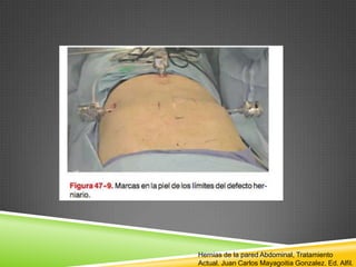 Hernias de la pared Abdominal, Tratamiento
Actual. Juan Carlos Mayagoitia Gonzalez. Ed. Alfil.
 