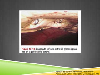 Hernias de la pared Abdominal, Tratamiento
Actual. Juan Carlos Mayagoitia Gonzalez. Ed. Alfil.
 