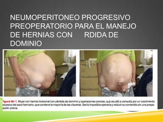 NEUMOPERITONEO PROGRESIVO
PREOPERATORIO PARA EL MANEJO
DE HERNIAS CON RDIDA DE
DOMINIO
 