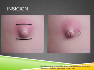 INSICION
Hernia umbilical en el adulto. Enciclopedia Medica Quirurgica,
Sociedad Española de Cirugia. 3ª Ed. 2007
 