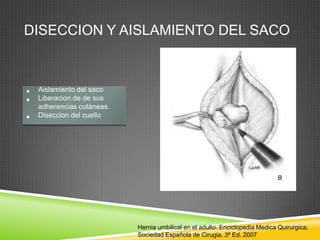 DISECCION Y AISLAMIENTO DEL SACO
• Aislamiento del saco
• Liberacion de de sus
adherencias cutáneas.
• Diseccion del cuello
Hernia umbilical en el adulto. Enciclopedia Medica Quirurgica,
Sociedad Española de Cirugia. 3ª Ed. 2007
 