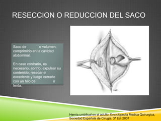 RESECCION O REDUCCION DEL SACO
Saco de o volumen,
comprimirlo en la cavidad
abdominal.
En caso contrario, es
necesario, abrirlo, expulsar su
contenido, resecar el
excedente y luego cerrarlo
con un hilo de n
lenta.
Hernia umbilical en el adulto. Enciclopedia Medica Quirurgica,
Sociedad Española de Cirugia. 3ª Ed. 2007
 