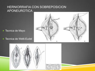 HERNIORRAFIA CON SOBREPOSICION
APONEUROTICA
 Tecnica de Mayo
 Tecnica de Welti-Eudel
 