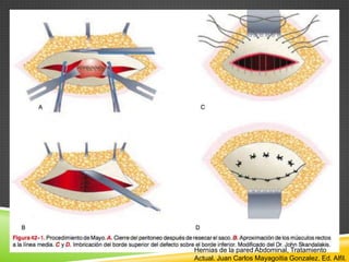 Hernias de la pared Abdominal, Tratamiento
Actual. Juan Carlos Mayagoitia Gonzalez. Ed. Alfil.
 