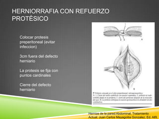 HERNIORRAFIA CON REFUERZO
PROTÈSICO
Colocar protesis
preperitoneal (evitar
infeccion)
3cm fuera del defecto
herniario
La protesis se fija con
puntos cardinales
Cierre del defecto
herniario
Hernias de la pared Abdominal, Tratamiento
Actual. Juan Carlos Mayagoitia Gonzalez. Ed. Alfil.
 