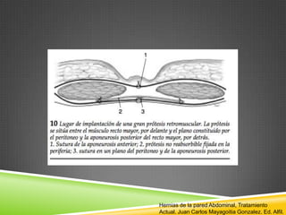Hernias de la pared Abdominal, Tratamiento
Actual. Juan Carlos Mayagoitia Gonzalez. Ed. Alfil.
 