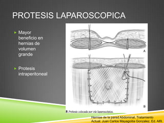 PROTESIS LAPAROSCOPICA
 Mayor
beneficio en
hernias de
volumen
grande
 Protesis
intraperitoneal
Hernias de la pared Abdominal, Tratamiento
Actual. Juan Carlos Mayagoitia Gonzalez. Ed. Alfil.
 