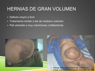 HERNIAS DE GRAN VOLUMEN
 Defecto mayor a 5cm
 Tratamiento similar a las de mediano volumen
 Piel ulcerada o muy voluminosa: onfalectomia
Hernias de la pared Abdominal, Tratamiento
Actual. Juan Carlos Mayagoitia Gonzalez. Ed. Alfil.
 