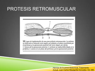 PROTESIS RETROMUSCULAR
Hernias de la pared Abdominal, Tratamiento
Actual. Juan Carlos Mayagoitia Gonzalez. Ed. Alfil.
 