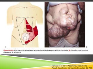 Hernias de la pared Abdominal, Tratamiento
Actual. Juan Carlos Mayagoitia Gonzalez. Ed. Alfil.
 