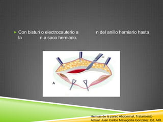 Con bisturi o electrocauterio a n del anillo herniario hasta
la n a saco herniario.
Hernias de la pared Abdominal, Tratamiento
Actual. Juan Carlos Mayagoitia Gonzalez. Ed. Alfil.
 