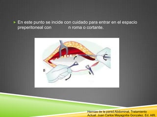  En este punto se incide con cuidado para entrar en el espacio
preperitoneal con n roma o cortante.
Hernias de la pared Abdominal, Tratamiento
Actual. Juan Carlos Mayagoitia Gonzalez. Ed. Alfil.
 