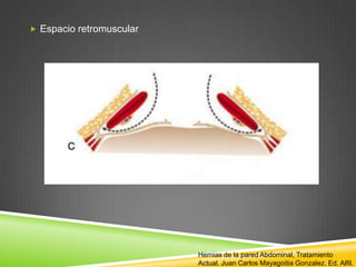  Espacio retromuscular
Hernias de la pared Abdominal, Tratamiento
Actual. Juan Carlos Mayagoitia Gonzalez. Ed. Alfil.
 