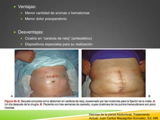  Ventajas:
 Menor cantidad de sromas o hematomas
 Menor dolor posoperatorio
 Desventajas:
 Cicatriz en “caratula de reloj” (antiestético)
 Dispositivos especiales para su realización
Hernias de la pared Abdominal, Tratamiento
Actual. Juan Carlos Mayagoitia Gonzalez. Ed. Alfil.
 