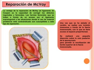 Mcvay Incision Pared abdominal: Hernias region inguino-crural | PPTX