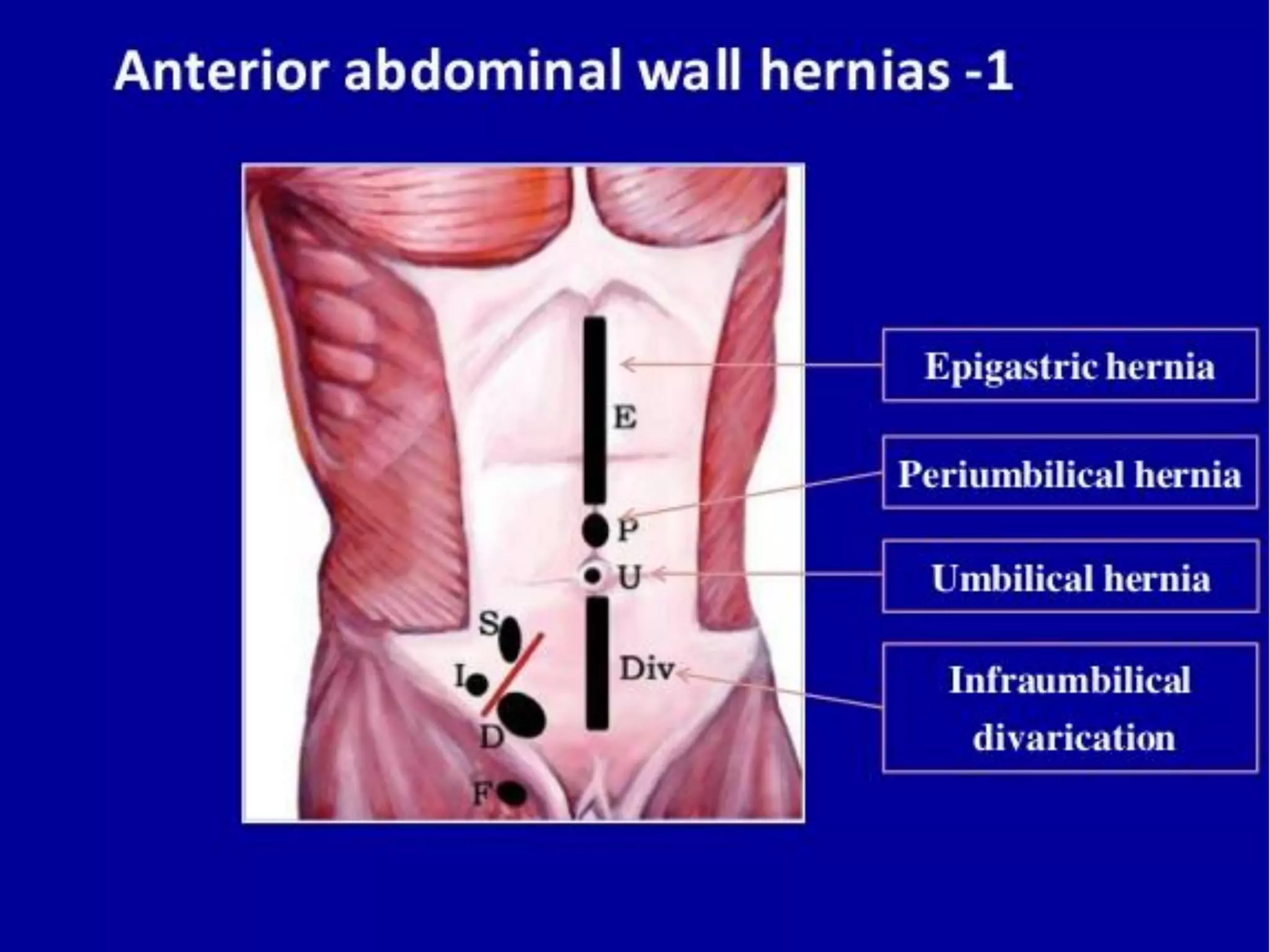 Parede abdominal (Anatomia e Hérnias) | PPT